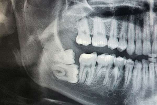 Wisdom teeth trouble